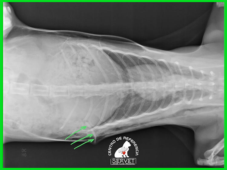 enfisema subcutáneo