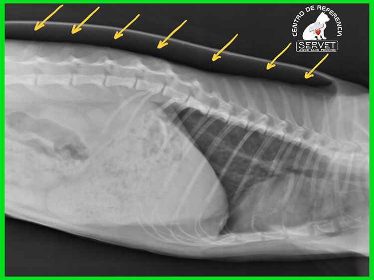enfisema subcutáneo