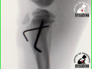 tornillo cirugia fractura tibia
