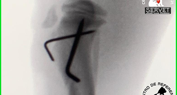 cirugia fractura tibia