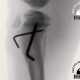 cirugia fractura tibia