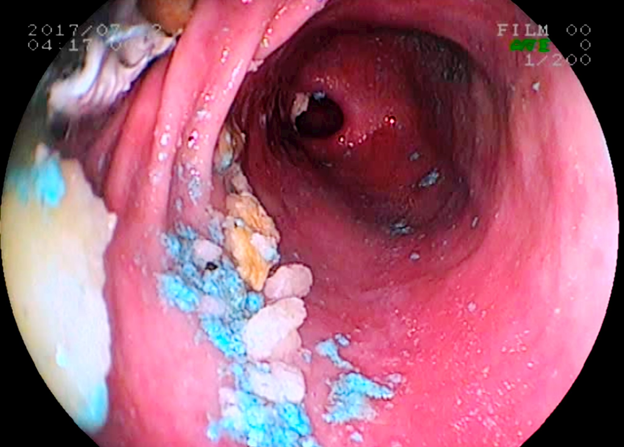 videoendoscópia videoendoscópia