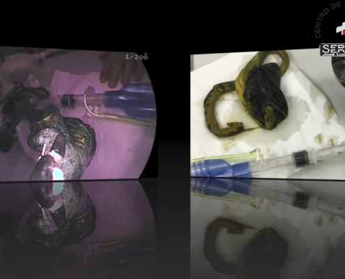 Cuerpo extraño ecografía y endoscopia