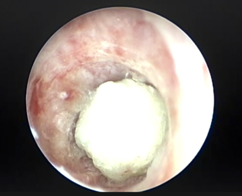Cistoscopia litiasis uretral