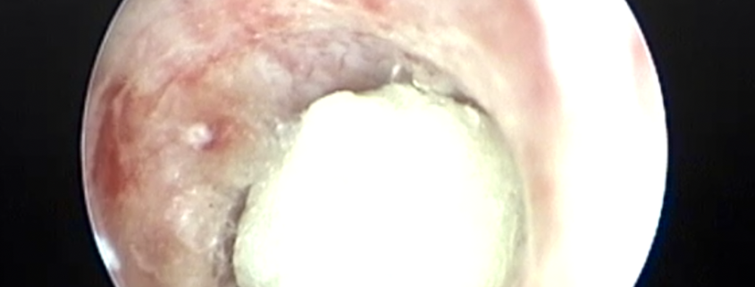 Cistoscopia litiasis uretral