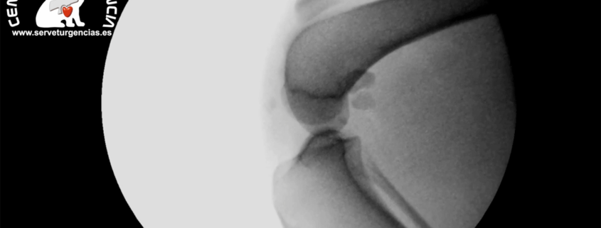 Cirugía rotura tendón rotuliano