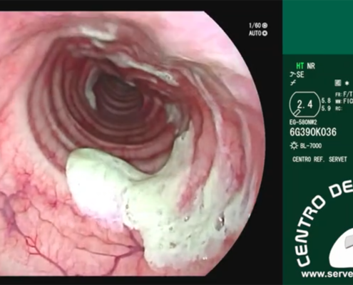 Endoscopia Laringotraqueitis