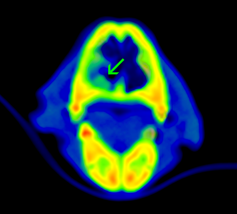 19 masa intranasal axial